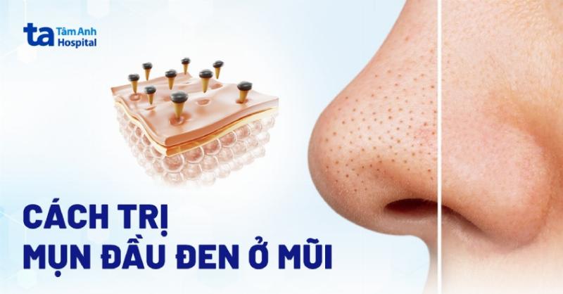 Cách Lấy Mụn Đầu Đen Không Cần Nặn: Bí Quyết Sở Hữu Làn Da Mịn Màng Chuẩn Khoa Học